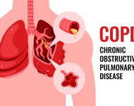 10 Things You Should Know About COPD